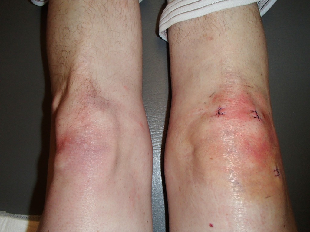 4 days post-op and the knee is looking almost rather normal.